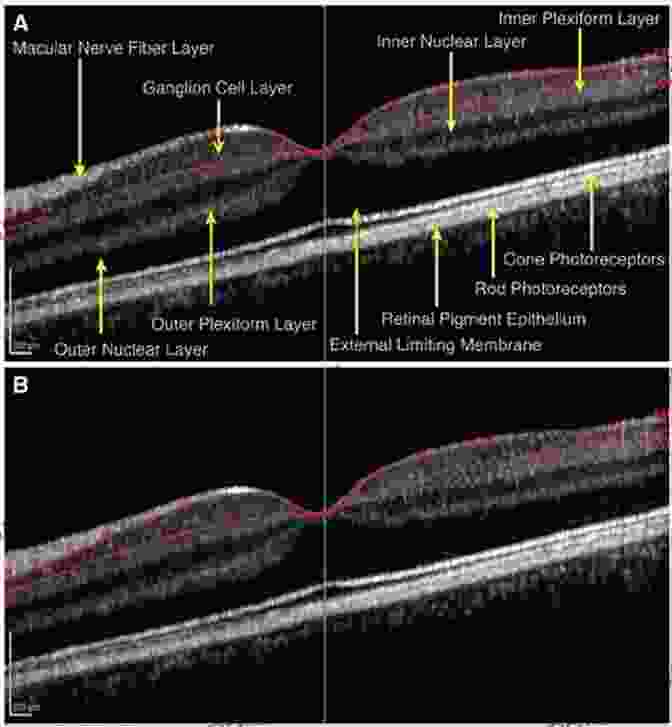 High Resolution OCT Image Of The Macula, Showcasing Its Intricate Layers Atlas Of Retinal OCT: Optical Coherence Tomography